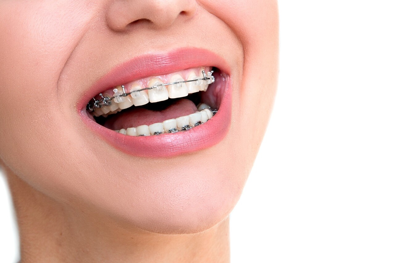 Orthodontic Treatment