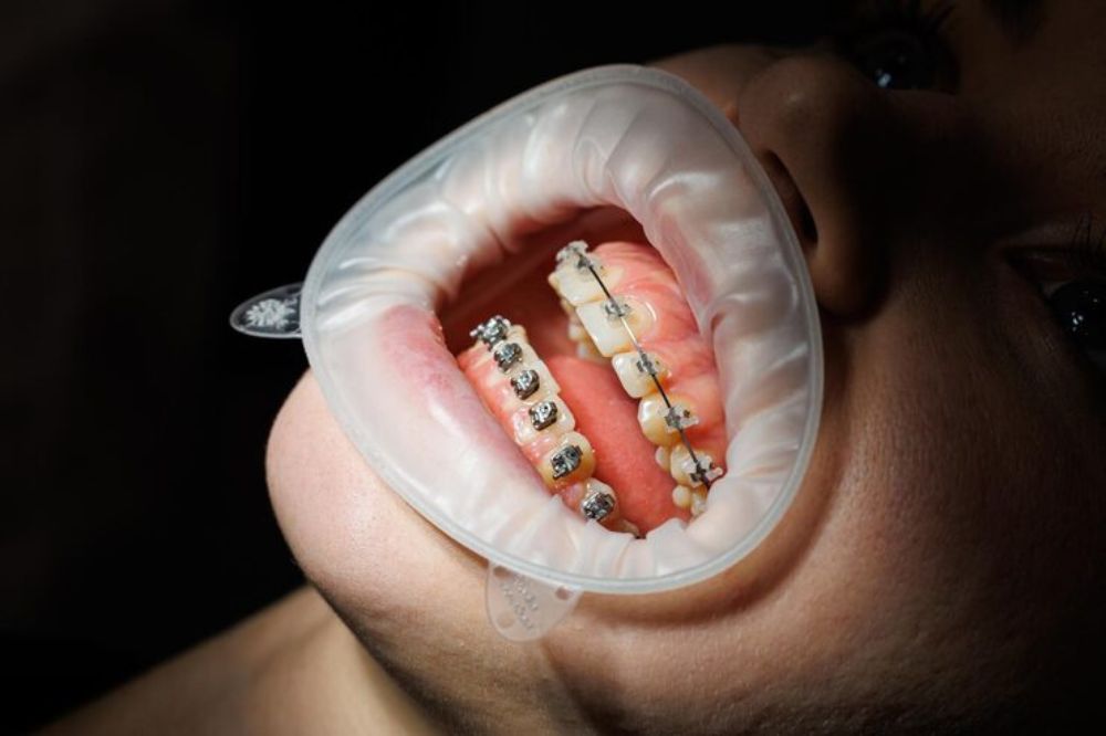 benefits of orthodontic treatment